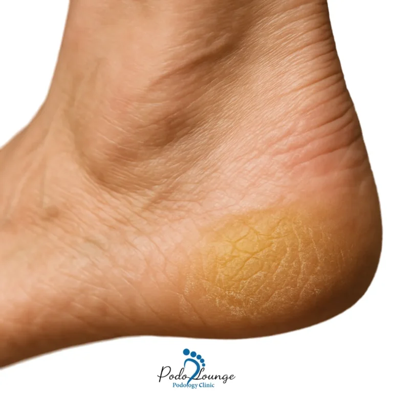 پینه کف پا-پینه زردرنگ و ضخیم در کف پا، نشانهای از فشار و اصطکاک مداوم، مرتبط با درمانهای پینه در کلینیک پُدولانژ.