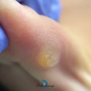 میخچه-میخچه (corn) روی انگشت پا، ضایعه پوستی سفت و کوچک، با مرکز برجسته و دردناک، مرتبط با فشار و اصطکاک، نمای نزدیک.