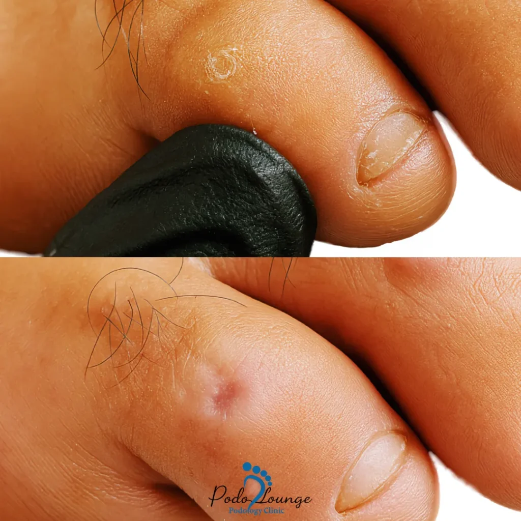 درمان میخچه-تصویر میخچه پا قبل و بعد از درمان در کلینیک پودولانژ، نشان‌دهنده تغییرات ظاهری و بهبود وضعیت پوست در ناحیه میخچه.