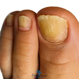 قارچ ناخن-ناخنهای زرد و ضخیم بهعنوان نشانهای از عفونت قارچی ناخن، با بافت پوست اطراف و لوگوی کلینیک پُدولانژ در پسزمینه.
