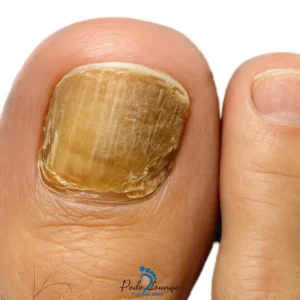 Onychomycosis
