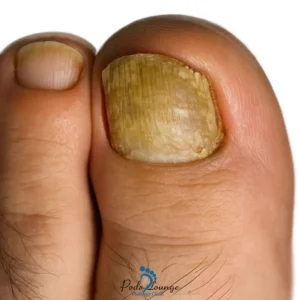 عفونت قارچی