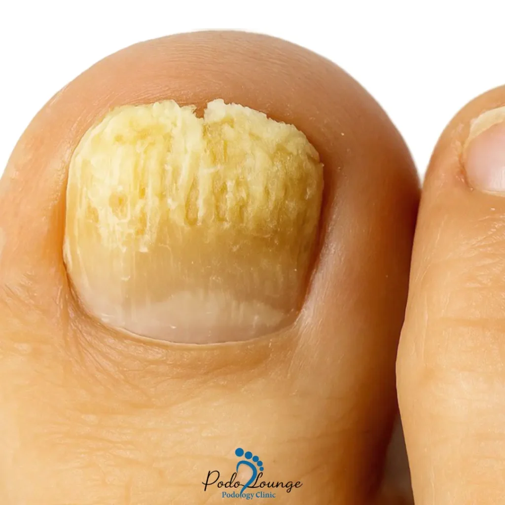 قارچ ناخن-ناخن آسیبدیده با عفونت قارچی، تغییر رنگ به زرد و ضخیمشدن، نشاندهنده علائم قارچ ناخن (Onychomycosis)، با لوگوی پُدولانژ در پایین تصویر.