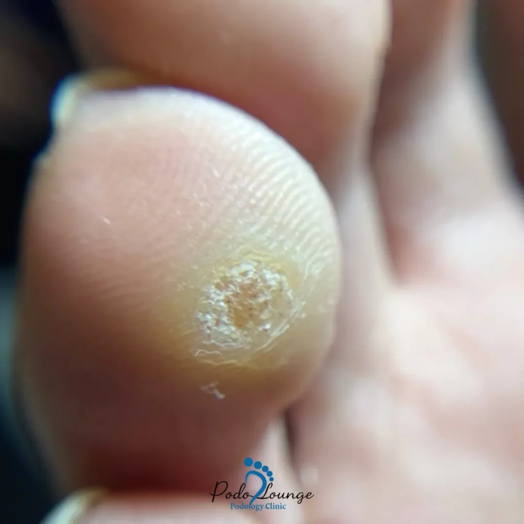 زگیل درمان زگیل دست و پا-زگیل کف پا با سطح خشن و نقاط سیاه، نمای نزدیک از ضایعه پوستی خوشخیم ناشی از ویروس پاپیلومای انسانی (HPV) در مرکز انگشت پا، مرتبط با درمان زگیل در پُدولانژ.