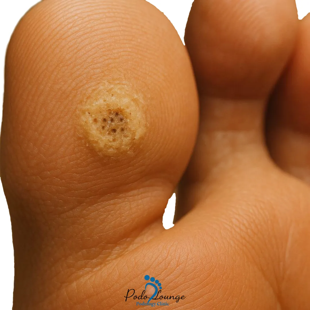 زگیل-زگیل کف پا با سطح زبر و نقاط تیره، نمای نزدیک از ضایعه پوستی در ناحیه پاشنه پا، مرتبط با ویروس پاپیلومای انسانی (HPV).