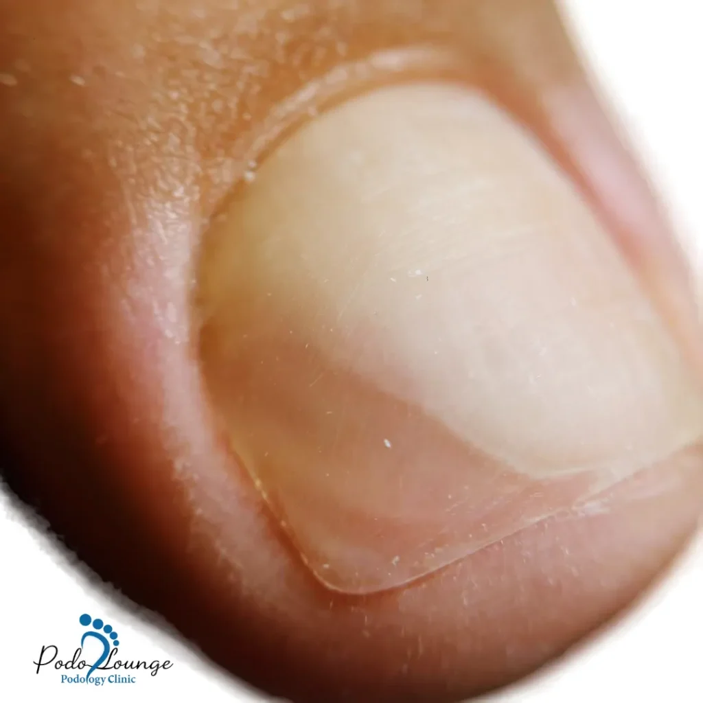 پروتز ناخن شفاف و طبیعی با پوشش محافظتی، مناسب برای بازسازی ظاهری ناخن‌های آسیب‌دیده در کلینیک پودولانژ.