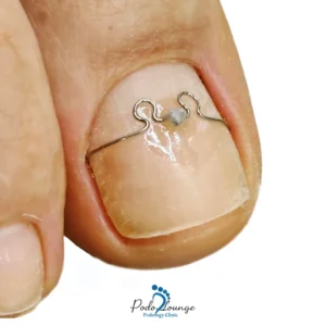 درمان ناخن فرو رفته-ناخن شست پا با ارتونیل درمان ناخن فرو رفته، نشاندهنده روشهای درمانی کلینیک پودولانژ برای دفرمگیهای ناخن.