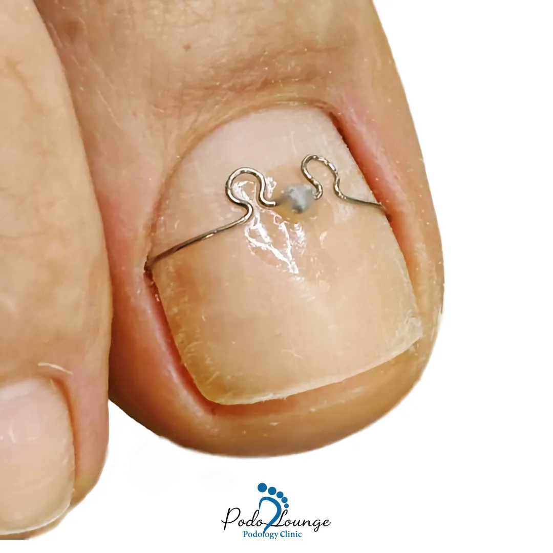 درمان ناخن فرو رفته-ناخن شست پا با ارتونیل درمان ناخن فرو رفته، نشاندهنده روشهای درمانی کلینیک پودولانژ برای دفرمگیهای ناخن.