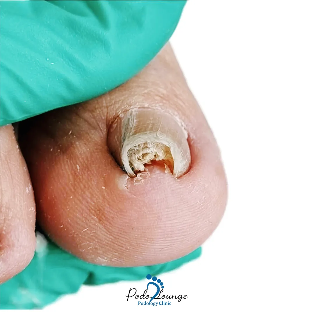 ناخن فرورفته-ناخن آسیبدیده با تغییر شکل، ضخامت و رنگ، نشاندهنده عفونت قارچی یا ناخن فرو رفته، دست در دست پزشک با دستکش در کلینیک پُدولانژ.