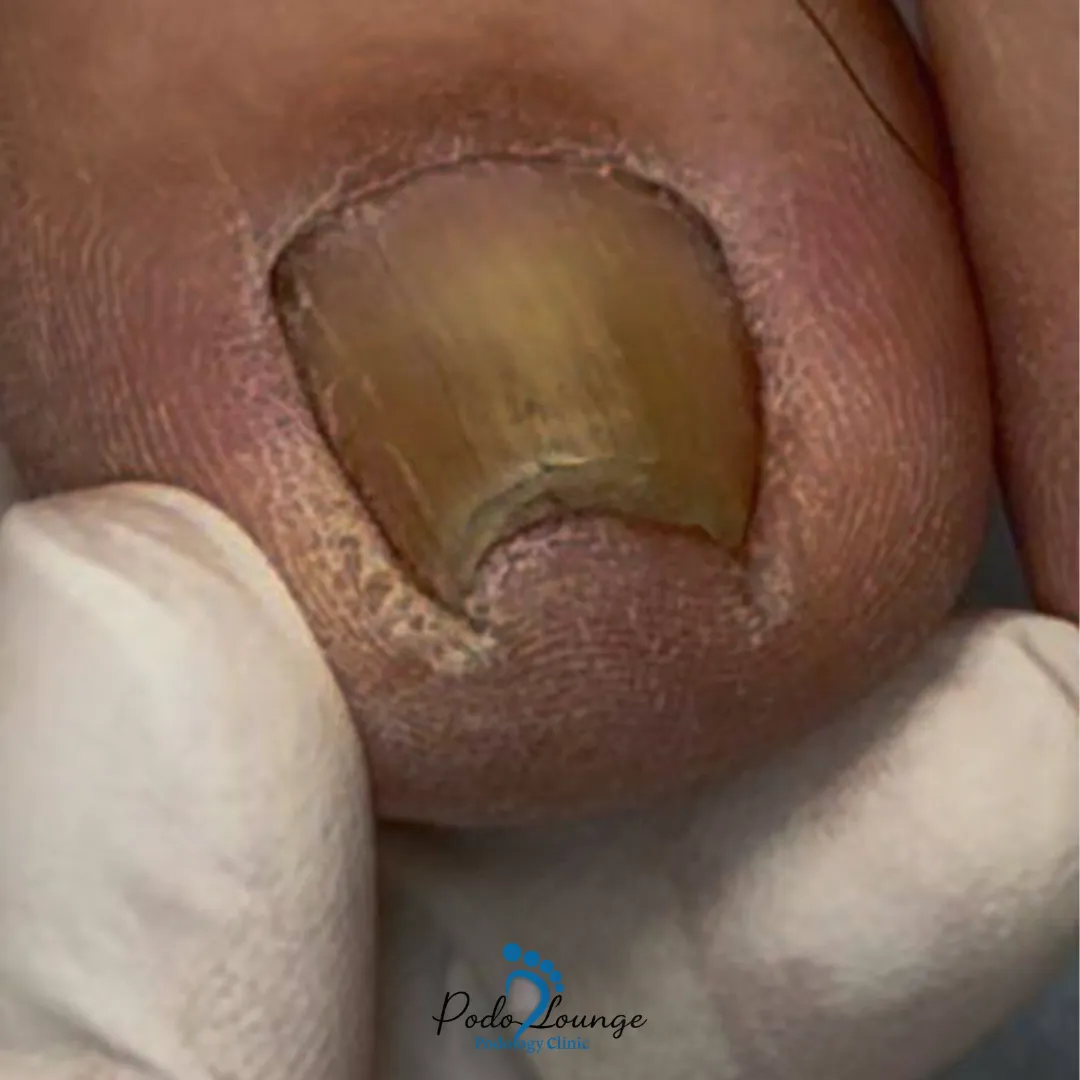 ناخن فرو رفته در گوشت