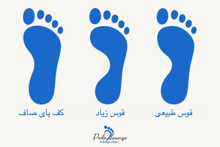 تشخیص صافی کف پا، قوس پا