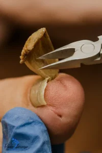 درمان ناخن شاخ قوچی