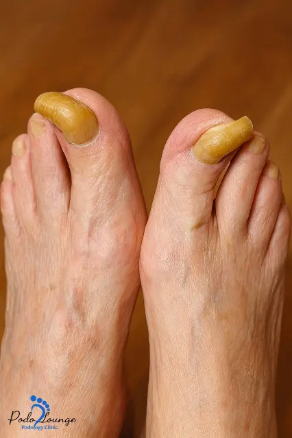 ناخن شاخ قوچی