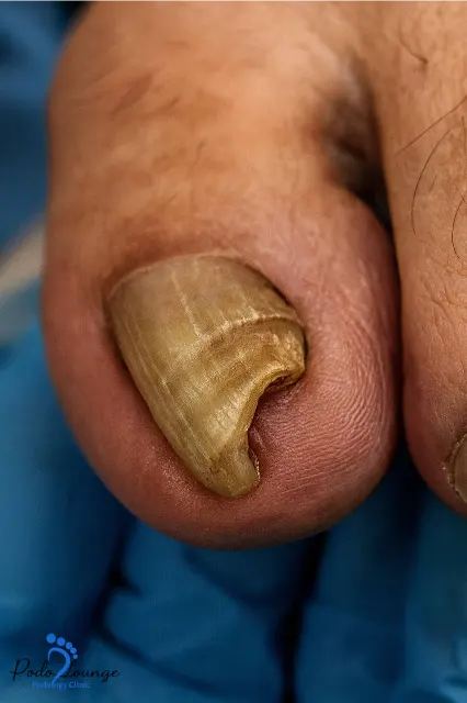 ناخن شاخ قوچی-ناخن شست پا با شکل منحنی و ضخیم، نشان‌دهندهٔ عارضهٔ اونیکوگریفوزیس، رنگ کدر و زرد، نمای نزدیک از ناخن غیرطبیعی.