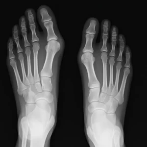 قوز انگشت پا