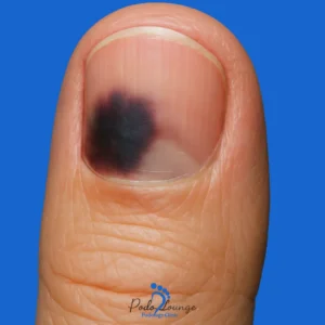 subungual hematoma