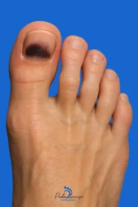 خون‌ مردگی زیر ناخن