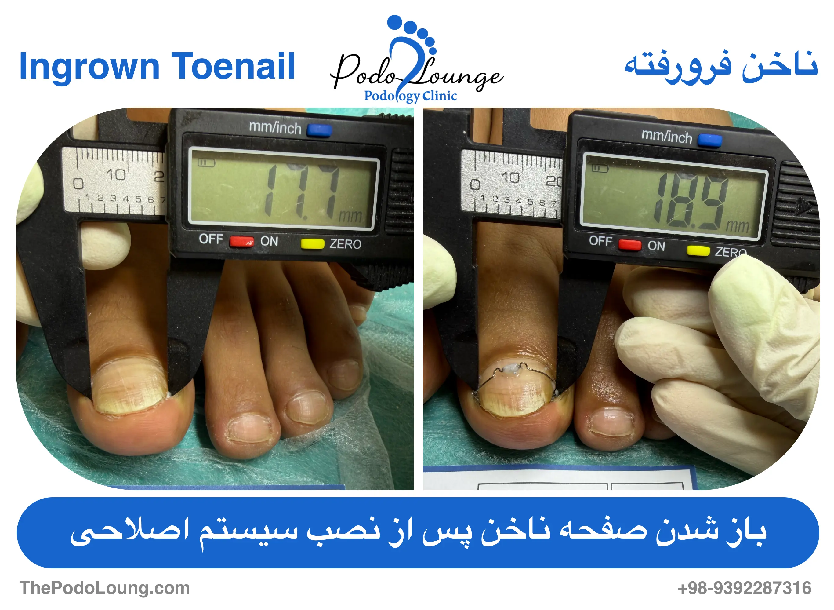 مقایسه اندازهگیری عرض صفحه ناخن پا با کولیس دیجیتال؛ در تصویر سمت راست بریس سیمی روی ناخن قرار دارد